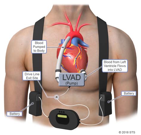 lvsd life expectancy|what does lvd mean.